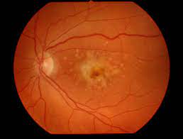 Recomendaciones para prevenir la degeneración macular asociada con la edad. 